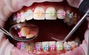 braces