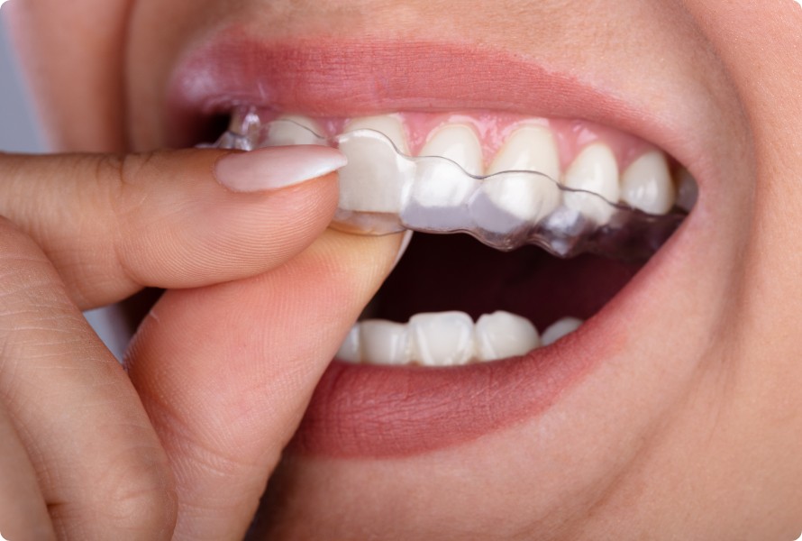 invisible teeth