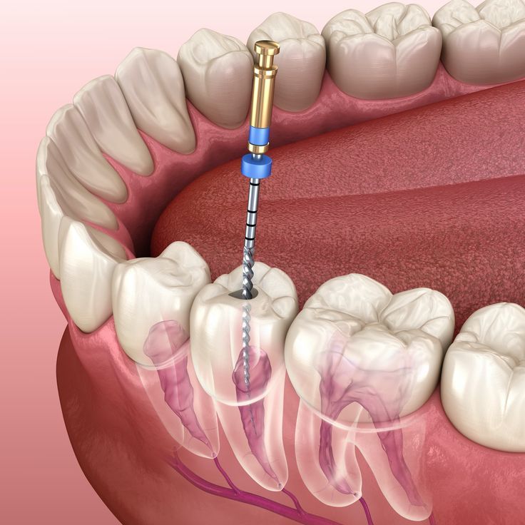 canal treatments